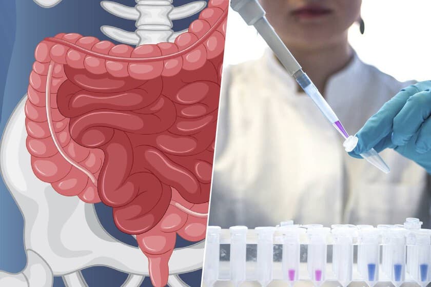 Gráfico que muestra el aumento de incidencia de cáncer colorrectal en jóvenes, con iconos de alimentos procesados y sede