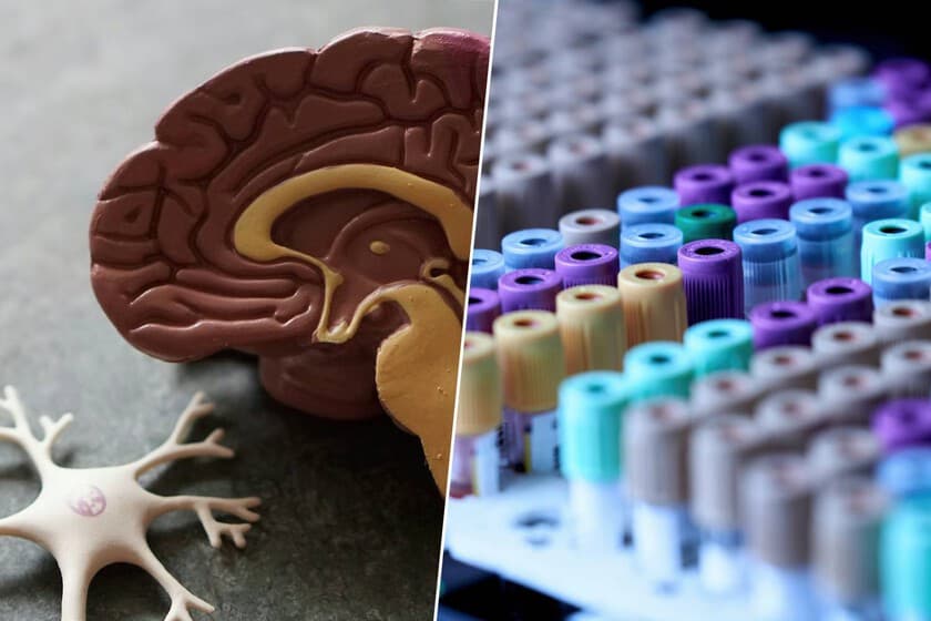 Muestra de sangre en laboratorio junto a un cerebro humano estilizado