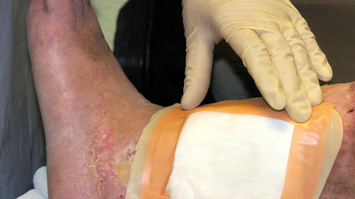Primer plano de gusanos de mosca sobre una herida en un entorno clínico controlado